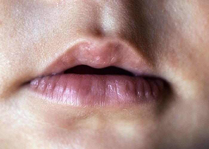 Может ли верхняя уздечка (уздечка губы) быть причиной трудностей с грудным вскармливанием у ребенка?